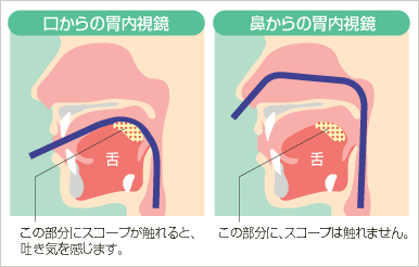 口からの内視鏡、鼻からの内視鏡